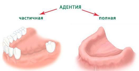 Виды адентии, классификация